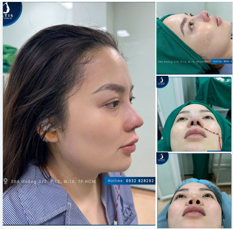 Xử lý thành công ca sửa mũi cho chị khách đến từ Hà Nội