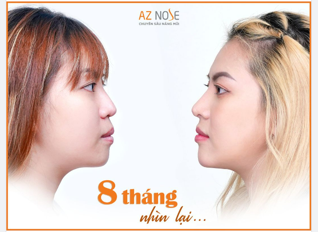 Ca tái tạo mũi h.ỏng thực hiện bởi Bác sĩ CKI. Đinh Xuân Sơn Tùng.