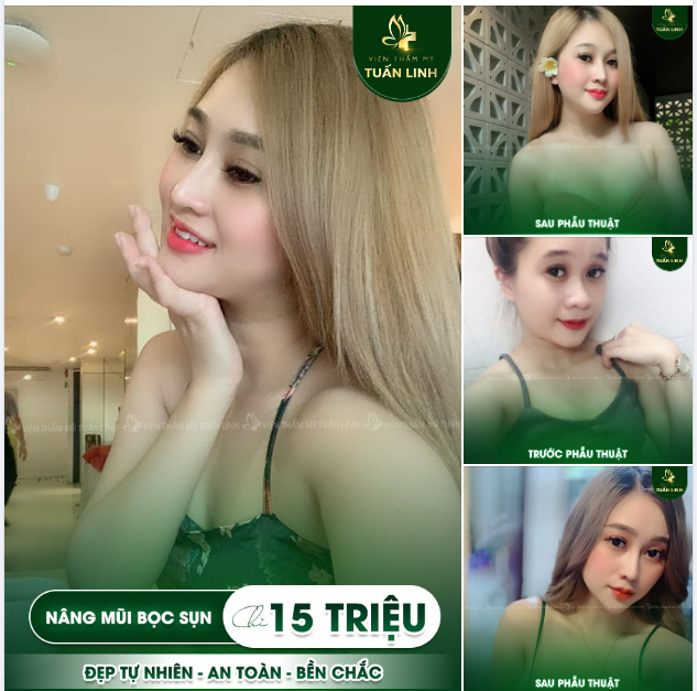 " Mình nâng mũi bọc sụn 3 năm rồi vẫn ưng ý như ngày đầu...''