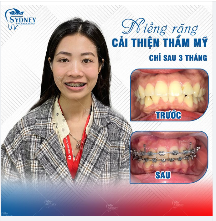 Tại sao cần niềng răng?