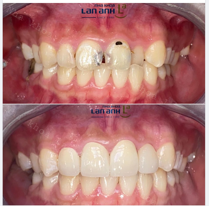 Hình ảnh 1 ca phục hình sứ Direkt răng 12-22 do BS Thuỷ- chi nhánh 292 thực hiện.