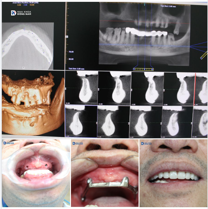 CASE THỰC TẾ 9 - IMPLANT ALL ON 4 TOÀN HÀM TRÊN