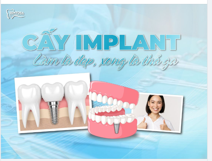 DEAL NGẬP TRÀN KHI CẤY IMPLANT - ƯU ĐÃI BÀNG HOÀNG CHỈ CÓ TẠI SENTOSA
