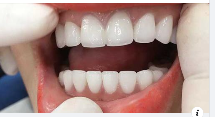So Sánh Hàm Giả Tháo Lắp Và Trồng Răng Implant