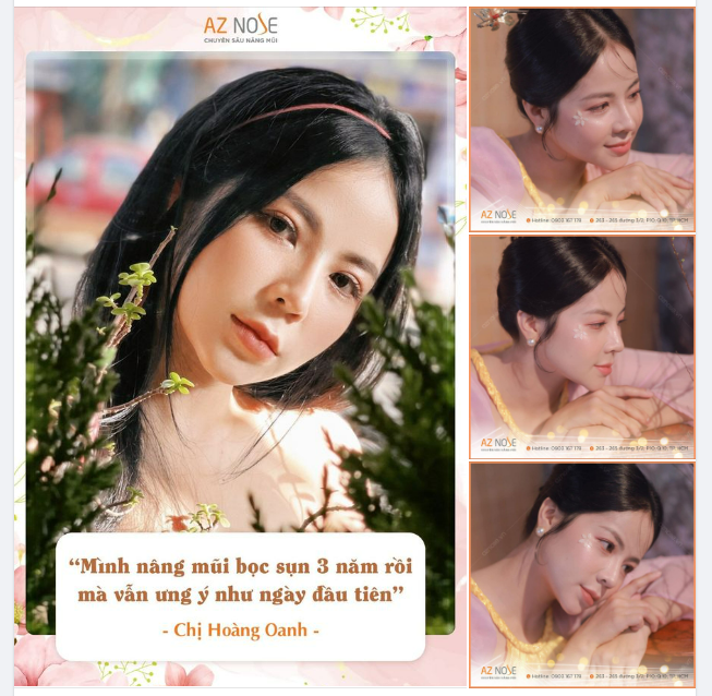 Dáng mũi cao xinh sau 3 năm nâng mũi bọc sụn