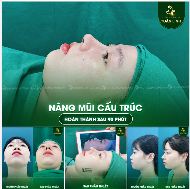 NÂNG MŨI CẤU TRÚC - DÁNG MŨI CAO TỰ NHIÊN