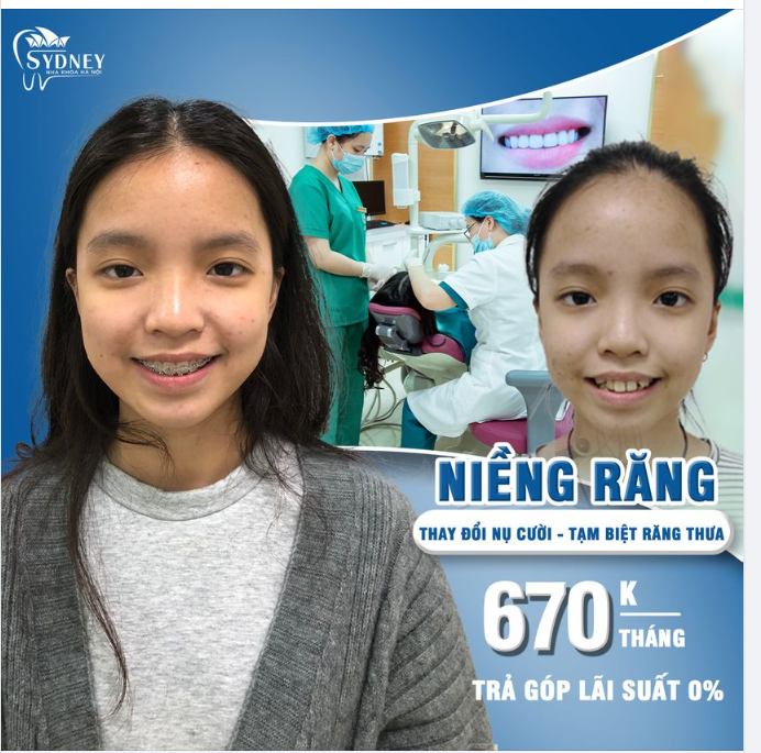 Làm sao để nhận biết răng bé bị thưa từ sớm?