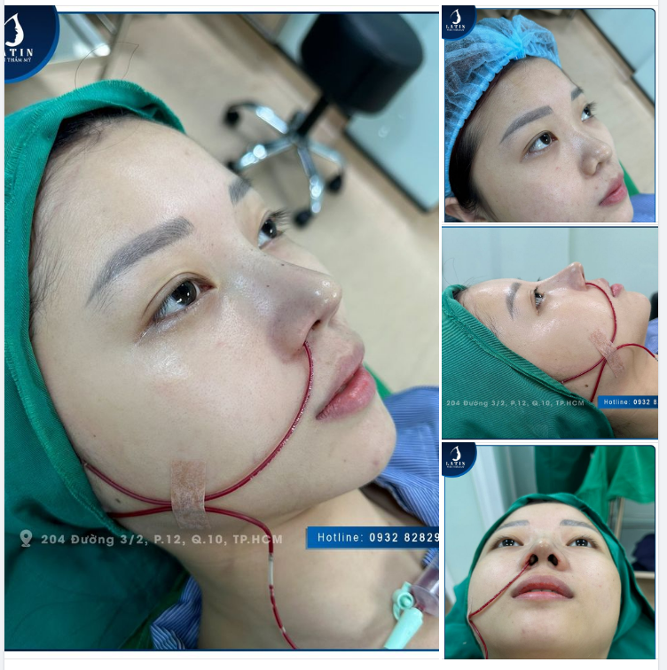 Khắc phục mũi thấp tẹt, không có sống mũi cho bạn khách hàng trẻ tuổi