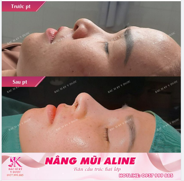 Một chiếc mũi cao tây hài hoà cho bạn khách Nha Trang.