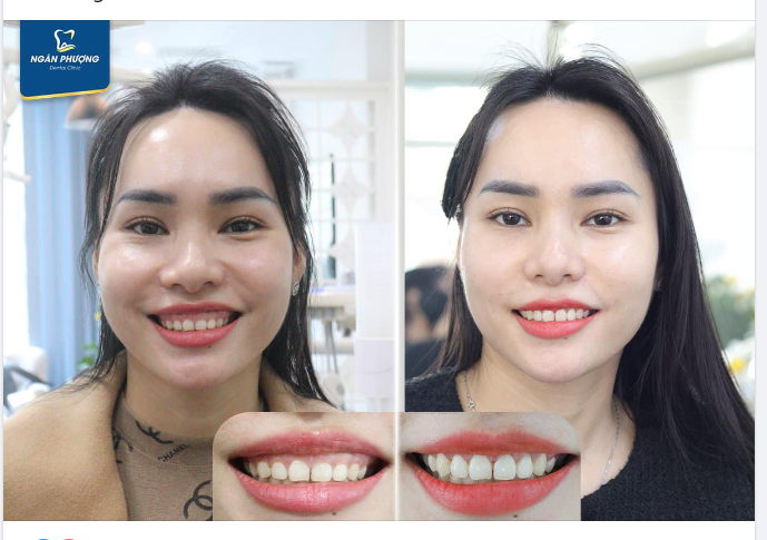 Chúc mừng chị và cảm ơn chị đã lựa chọn Nha khoa Ngân Phượng.