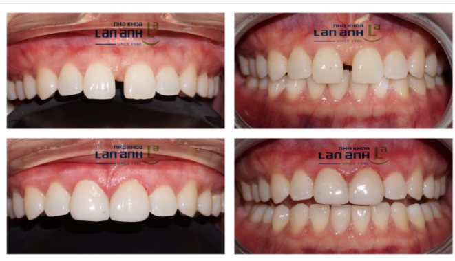 Nếu bạn từng mất tự tin vì răng cửa bị thưa.