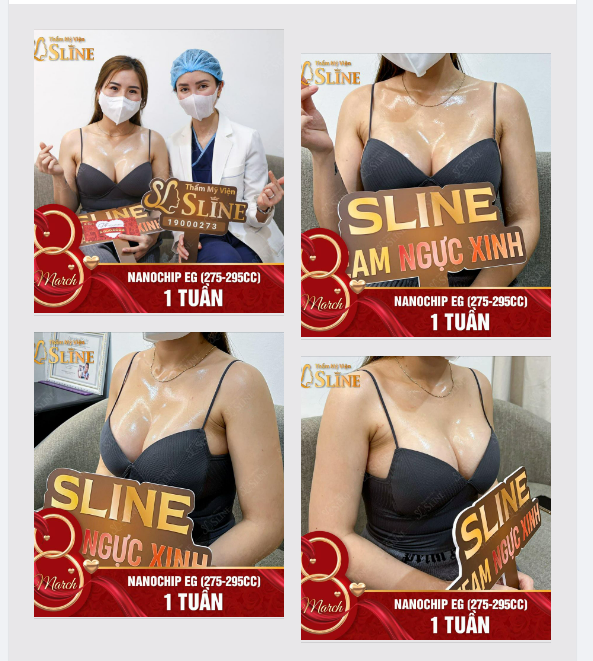 "Hối hận vì không làm ngực sớm hơn" feedback nâng ngực sau 1 tuần với Ekip Sline.