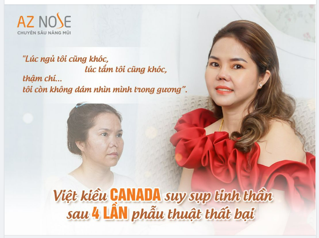 4 lần sửa mũi và 3 năm sống trong m.ặc c.ảm vì chiếc mũi bị h.ỏng n.ặng