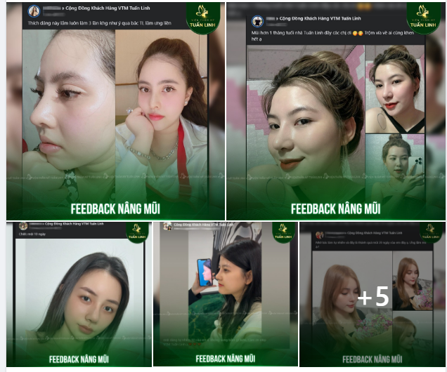 Feedback nâng mũi từ 100% khách hàng thật 