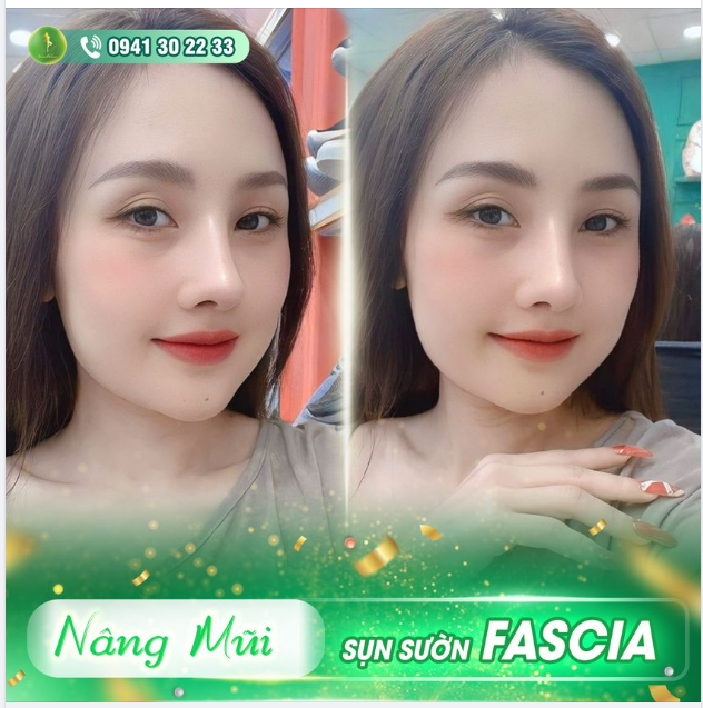 TỶ LỆ VÀNG BỀN VỮNG VỚI MŨI CẤU TRÚC SỤN SƯỜN