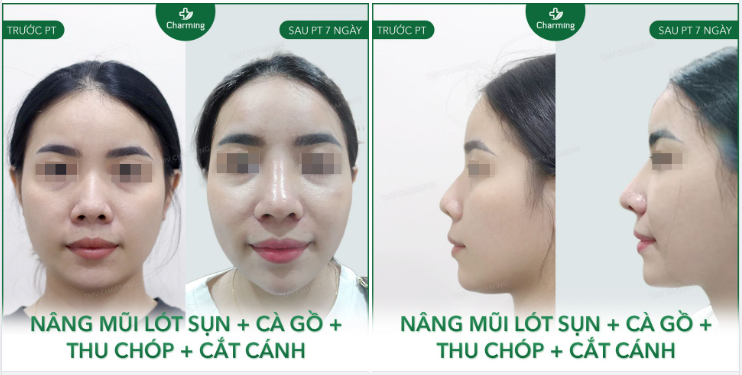 THAY ĐỔI GÓC NGHIÊNG VÀ VẺ ĐẸP CHO CHỊ KHÁCH U30