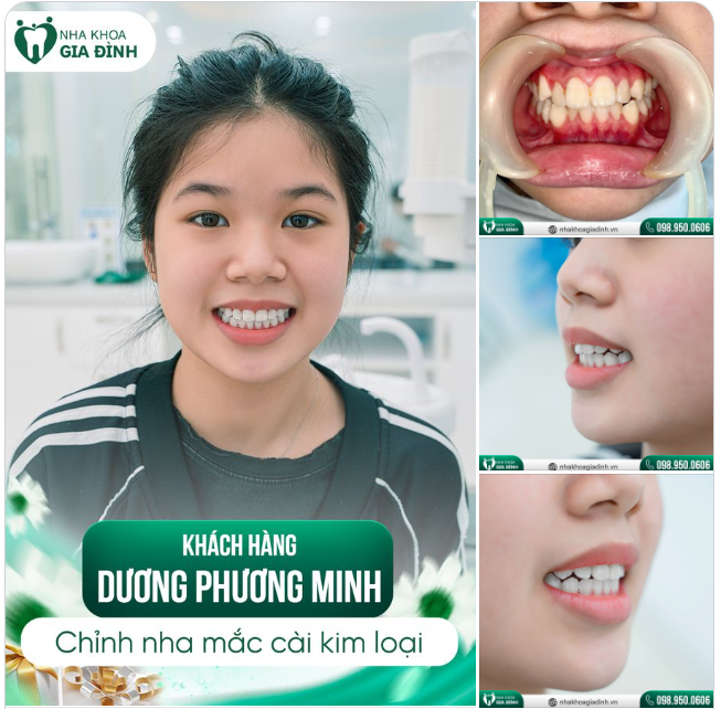 CÙNG NGẮM NHÌN KẾT QUẢ NIỀNG RĂNG CỦA KHÁCH HÀNG 14 TUỔI