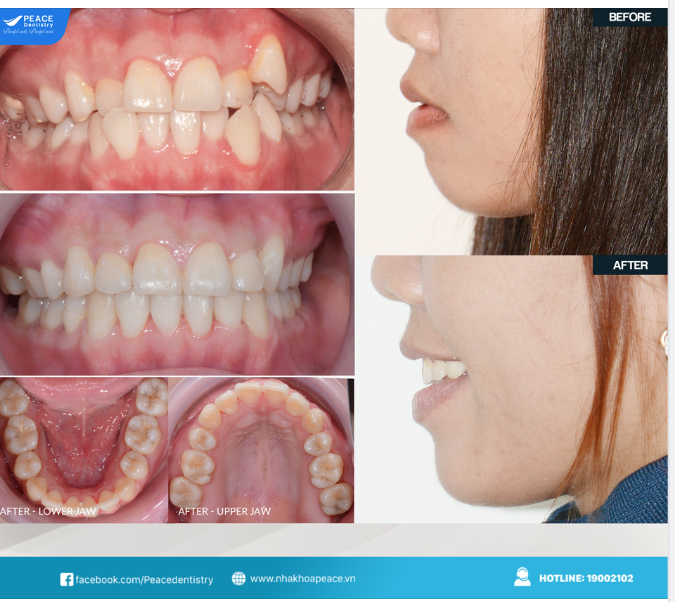Nụ cười đẹp hơn nhờ niềng răng