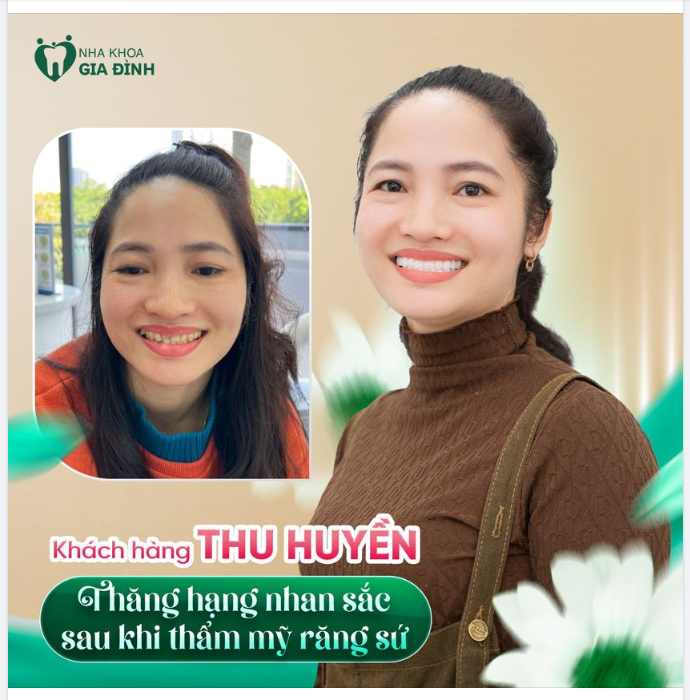 SỰ THAY ĐỔI KHÁC BIỆT SAU KHI THẨM MỸ RĂNG SỨ