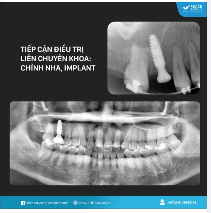 Trồng một lần sử dụng trọn đời, thẩm mỹ cao hơn, sức khỏe răng miệng nói chung tốt hơn.