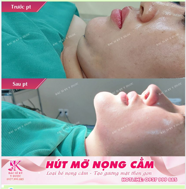 Hút mỡ nọng cằm - Phương pháp loại bỏ nọng cằm chỉ trong "một nốt nhạc"