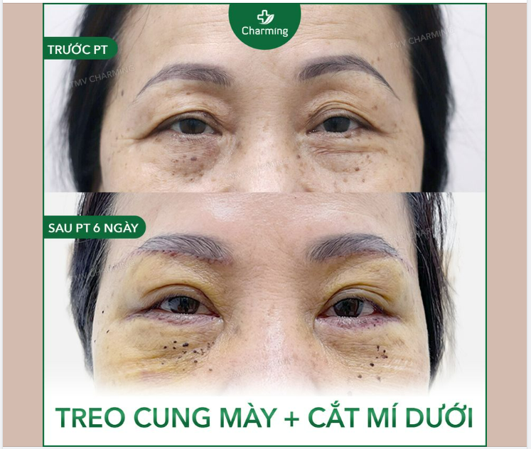 Cung mày sụp cộng thêm tình trạng mỡ mí dưới nhiều khiến cho đôi mắt lúc nào trông cũng rầu rầu như cơn sầu đắng môi .