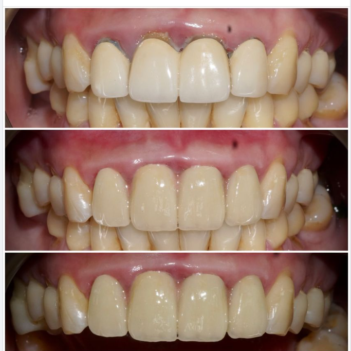 Một ca phục hình cầu răng sứ Direkt của bác sĩ Tùng Tại Chi nhánh Nam Long.