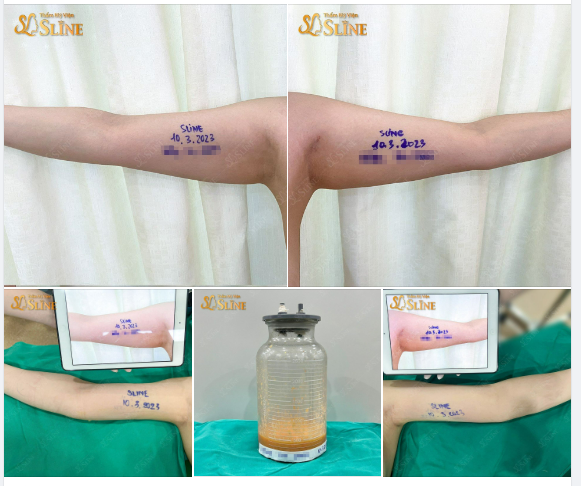 HÚT MỠ CÁNH TAY - HÈ NÀY TỰ TIN NGAY