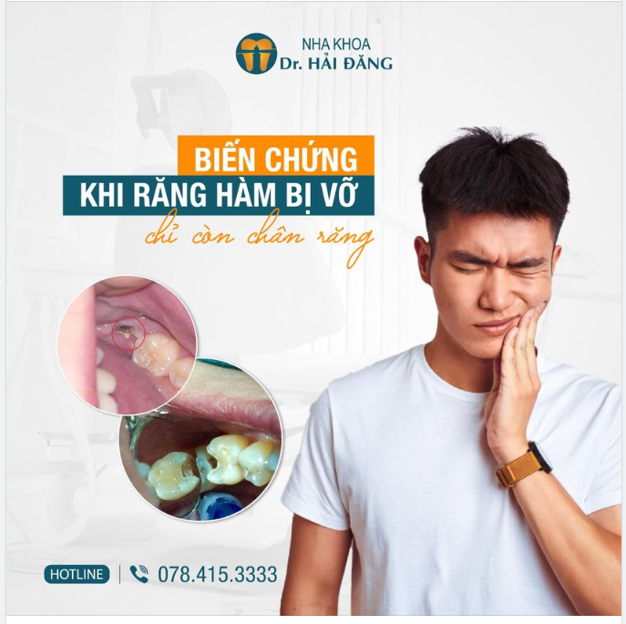 ​​​​​​​ NHỮNG BIẾN CHỨNG KHI RĂNG HÀM SÂU VỠ CHỈ CÒN LẠI CHÂN RĂNG.