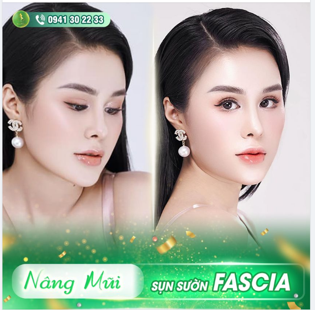 FEEDBACK KHOE DÁNG MŨI CẤU TRÚC SỤN SƯỜN FASCIA