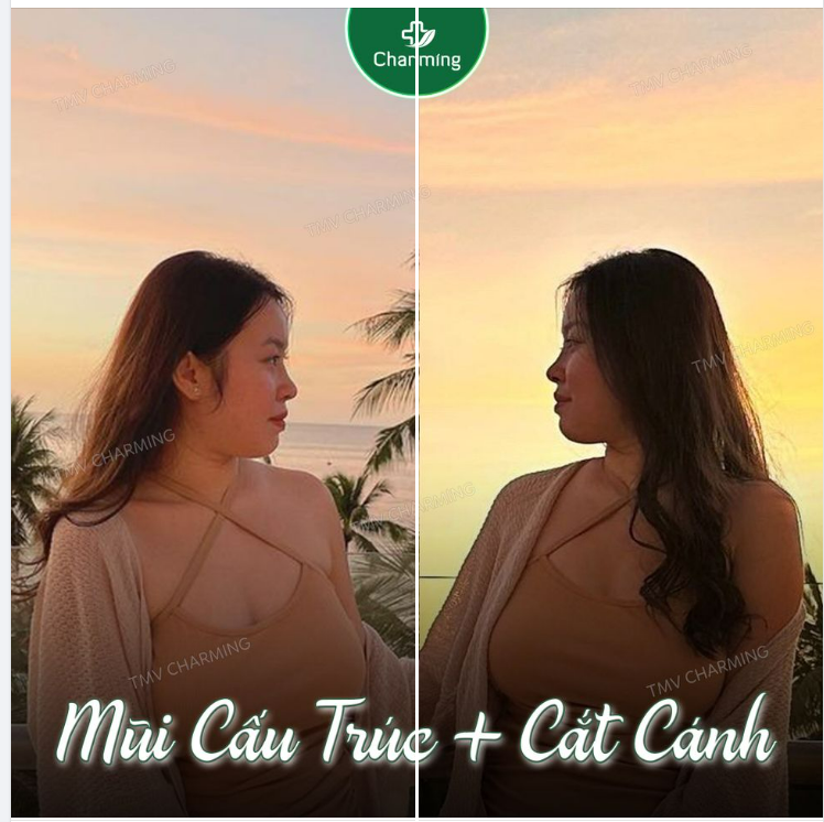 Chị KH gửi hình ảnh Feedback đến nhà Charming với niềm vui khó tả vì bác Khanh đã giúp chị cải thiện dáng mũi đẹp tự nhiên như các diễn viên Hàn Quốc.