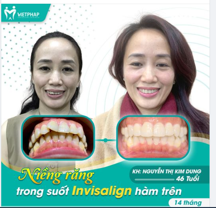 AI NÓI U50 KHÔNG NIỀNG RĂNG ĐƯỢC?