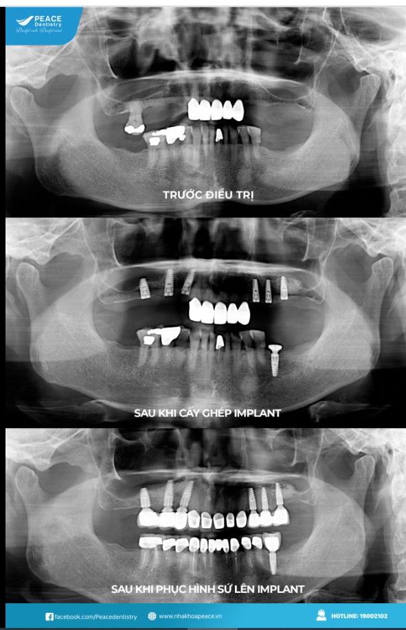 Ca lâm sàng trồng răng implant cho khách hàng mất nhiều răng, mất răng lâu năm, tiêu nhiều xương