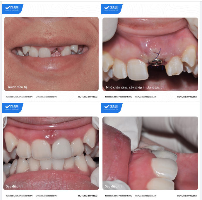 NHỔ RĂNG VÀ CẤY GHÉP IMPLANT TỨC THÌ - MỘT CHỈ ĐỊNH TỐI ƯU VỚI NHIỀU LỢI ÍCH CHO KHÁCH HÀNG