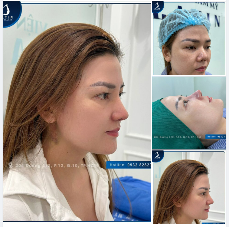 Tái khám mũi sửa lại sau 7 ngày, không sưng đau, không để lại sẹo: