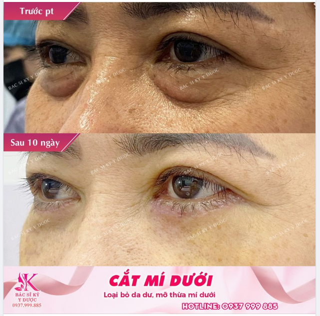 Phương pháp CẮT MÍ DƯỚI giúp níu giữ thanh xuân.