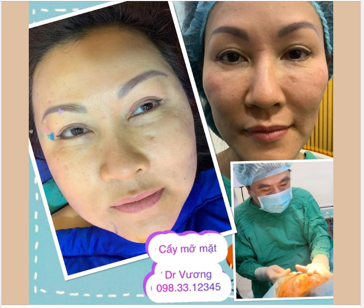 Cấy mỡ mặt cho bạn gái đến từ miền Trung …