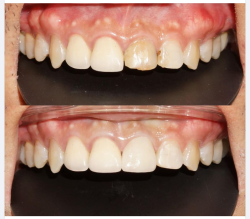  Một trường hợp phục hình sứ Lava 3M răng 21 tại chi nhánh 149 Tôn Dật Tiên do Bác sỹ Hoài điều trị