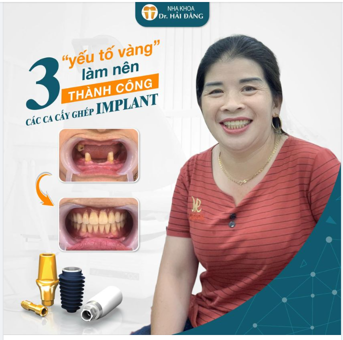Hãy cùng Nha Khoa Hải Đăng tìm hiểu điều gì làm nên thành công sau mỗi ca cấy ghép implant nhé!