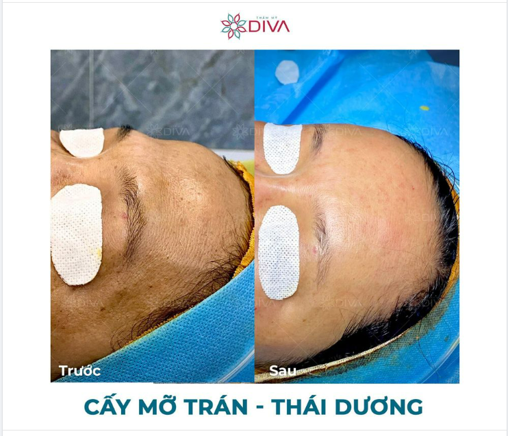 HÓP THÁI DƯƠNG, TRÁN - PHƯƠNG PHÁP NÀO ĐIỀU TRỊ TỐT NHẤT?