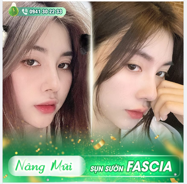 MŨI SỤN SƯỜN SIÊU ƯU ĐÃI TRONG THÁNG 3 - ĐẶT LỊCH NGAY