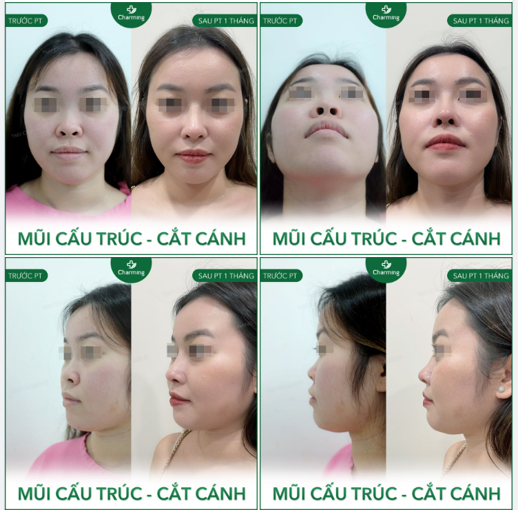 Một pha cứu cánh cho chiếc mũi thấp, tẹt và ngắn. Dù vẫn có thể cải thiện bằng phương pháp nâng mũi lót sụn nhưng không thể khắc phục khuyết điểm một cách toàn diện được.