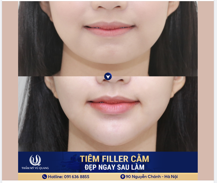 Cằm Tiêm Filler Cứng Hay Mềm? Tất Cả Những Điều Bạn Cần Biết!