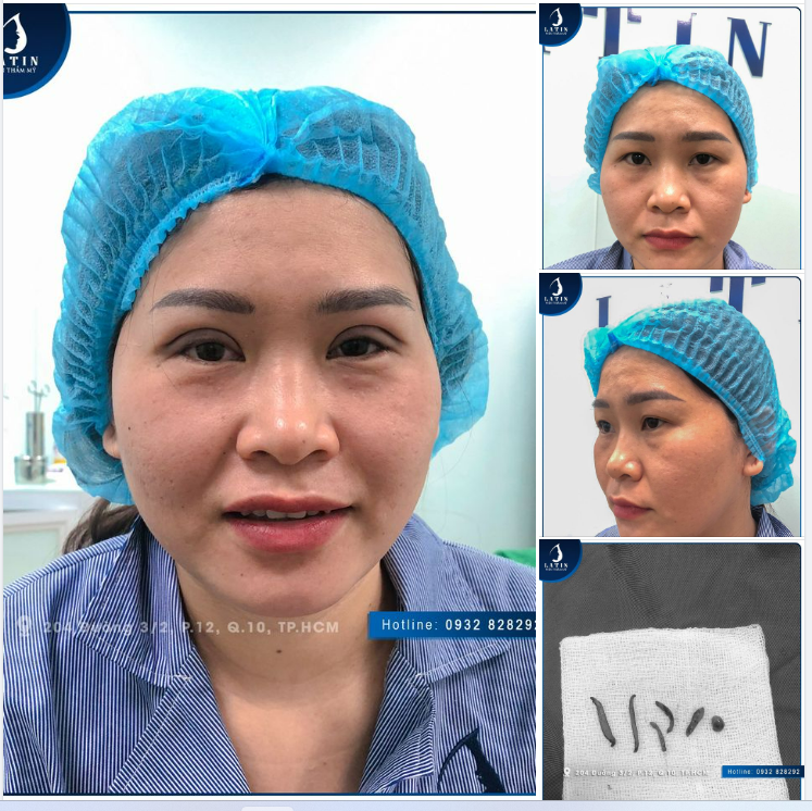 Kết quả cắt mí 4D - đẹp ngay khi mới làm xong