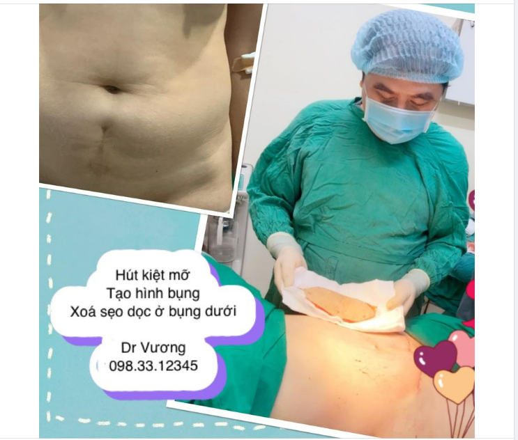 Thon gọn V2 với Dr Vương = hút kiệt mỡ, hút siết eo tạo hình bụng, siết cơ !