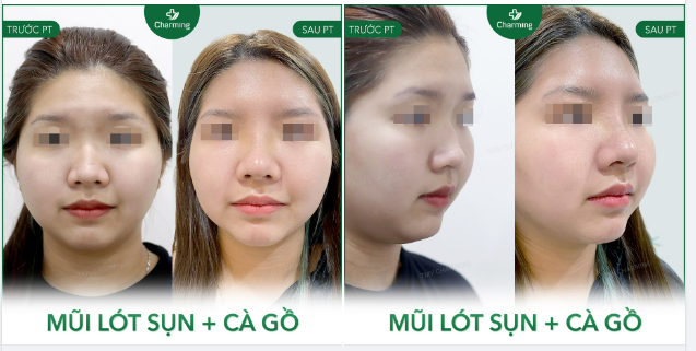 Đến với Charming chẳng cần tư vấn hay bày vẽ phương pháp cầu kỳ, cứ đúng khuyết điểm thì áp dụng đúng phương pháp là ra