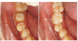 Một ca phục hình răng bể vỡ bằng cách bọc sứ của bác sĩ Vi, chi nhánh 149 Tôn Dật Tiên, Q.7!