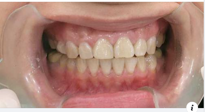 Vì sao phải gắn răng tạm khi trồng răng implant?