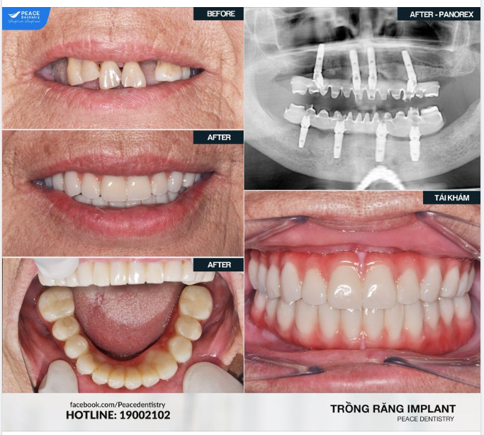 ALL-ON-4 IMPLANT