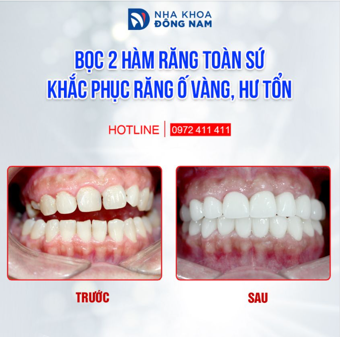 Cùng nhìn ngắm kết quả của khách hàng bọc 2 hàm răng sứ Hi-Zirconia tại Nha khoa Đông Nam.
